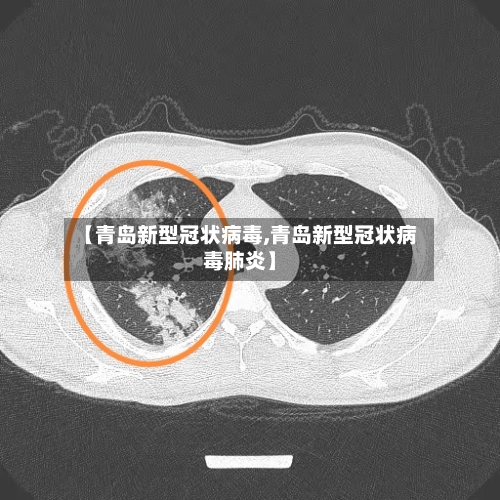 【青岛新型冠状病毒,青岛新型冠状病毒肺炎】