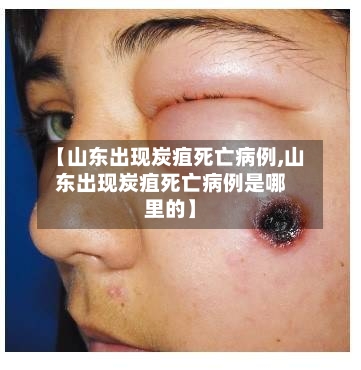 【山东出现炭疽死亡病例,山东出现炭疽死亡病例是哪里的】-第2张图片